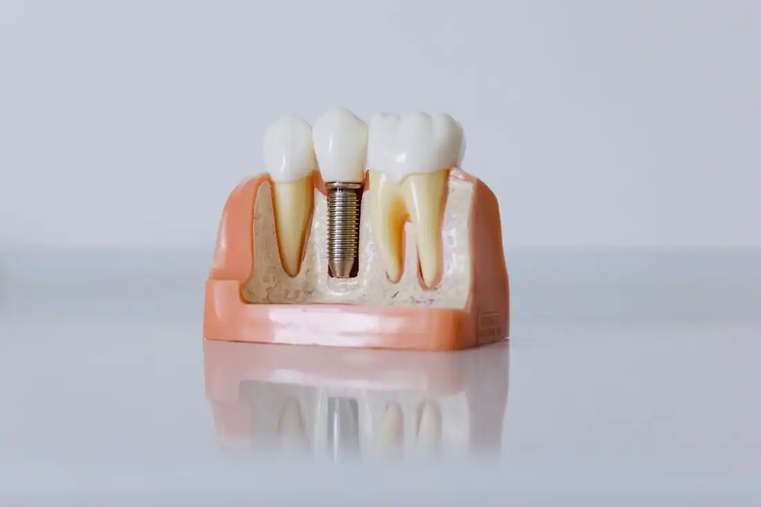 dental implant model