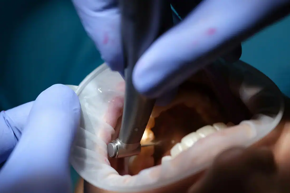dentist drilling tooth