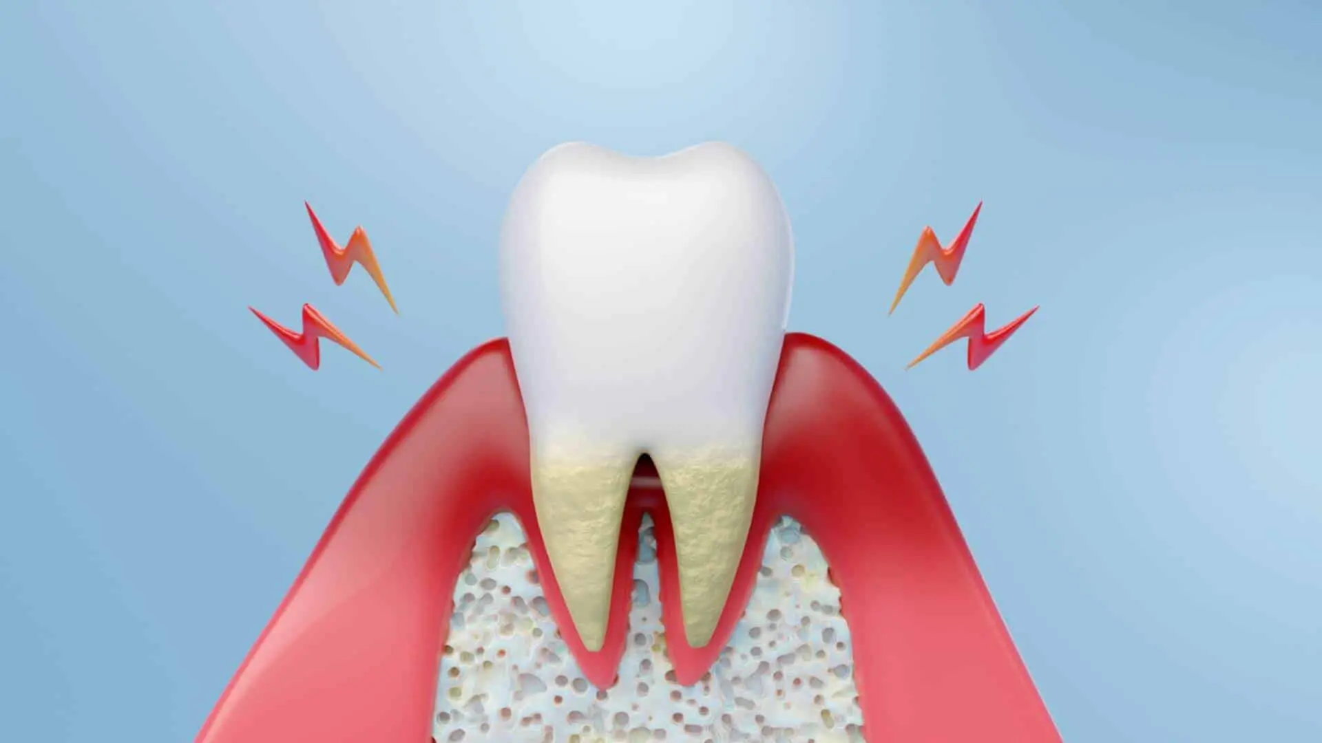 Periodontal Disease treatment