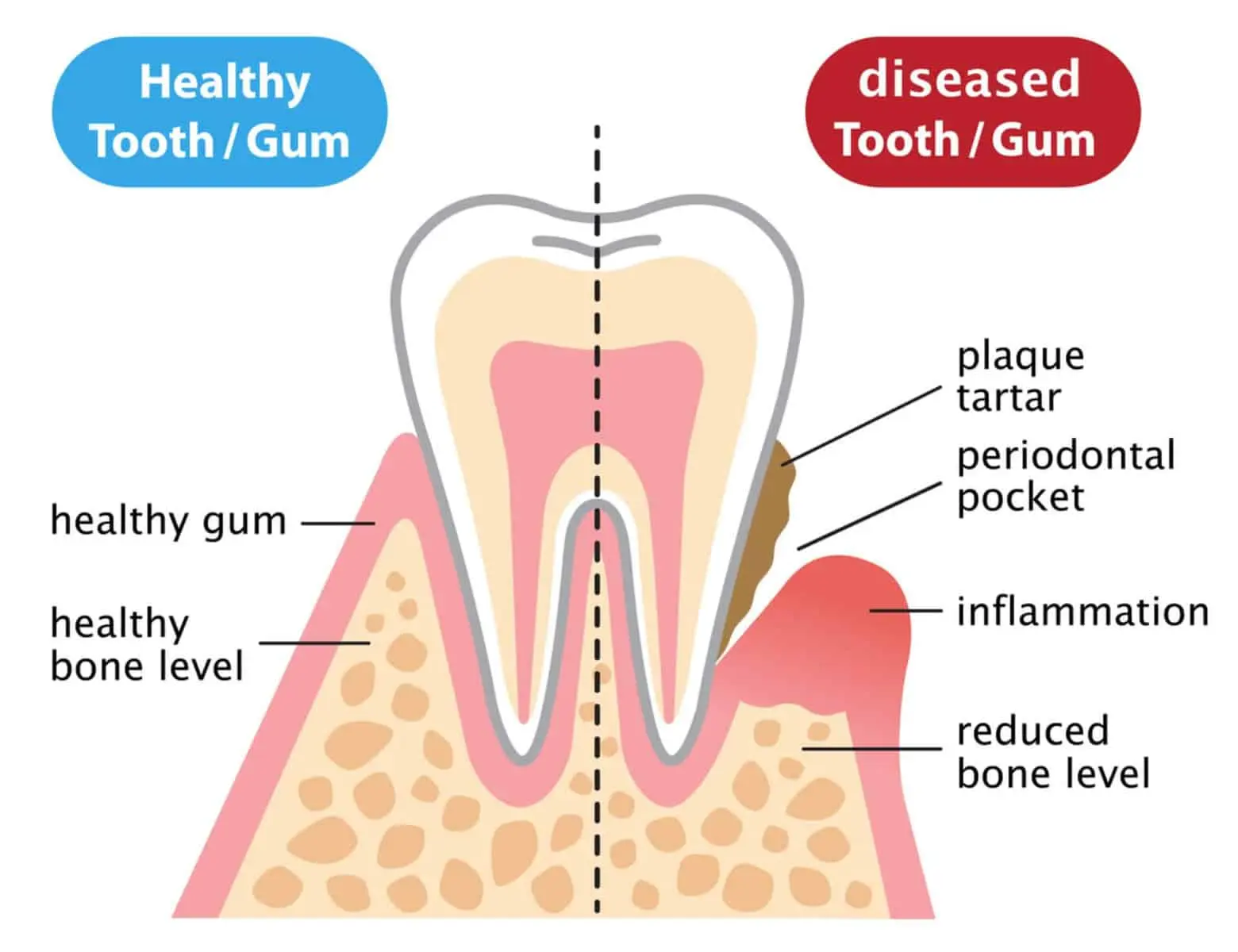 Preventive Strategies for teeth and gum disease