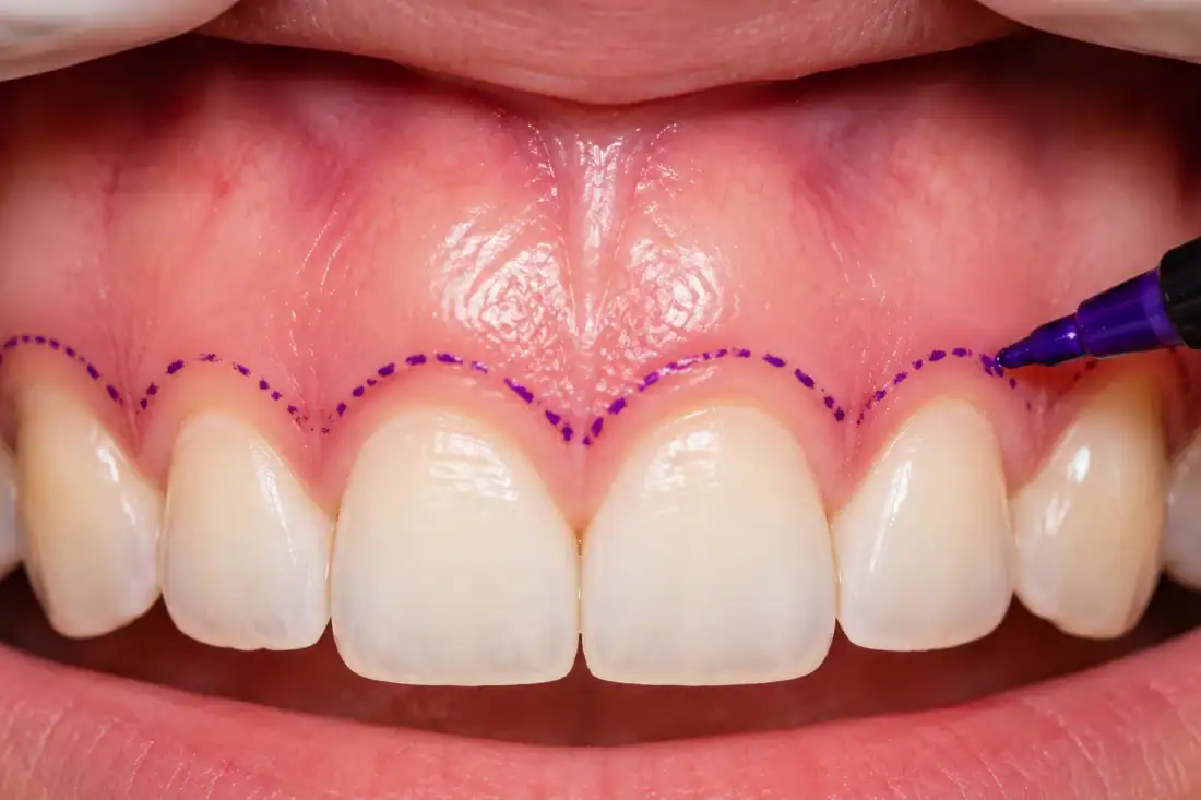 gum with purple marker lines for gum contouring surgery