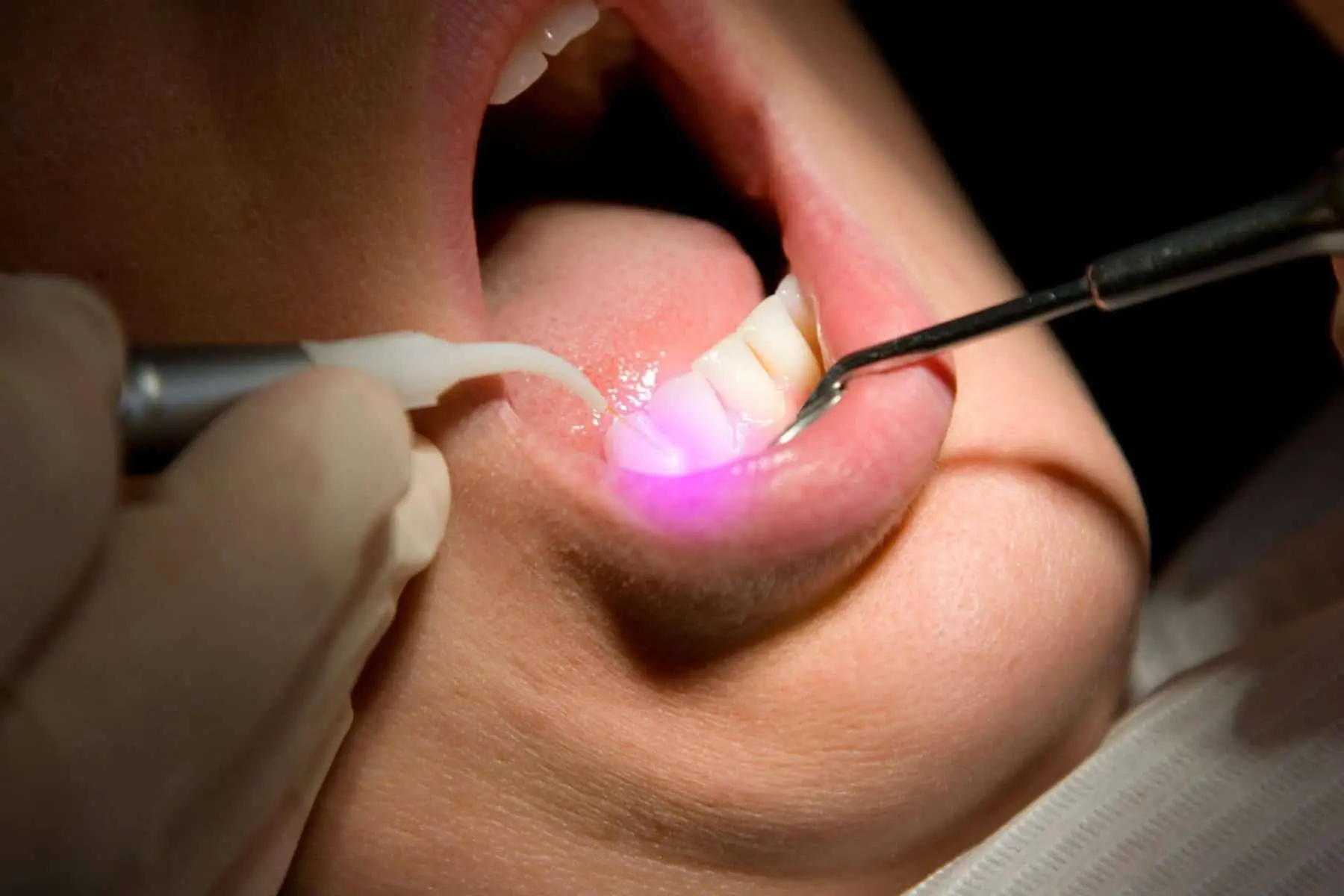 laser dentistry for the treatment of soft tissue problems
