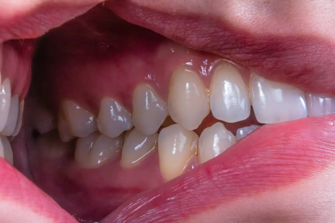 patient showing a form of gum disease