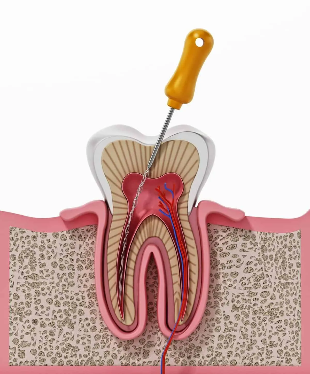 Root Canal Problems Treatment
