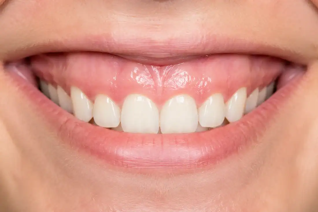 smile with visible large gums before cosmetic procedure